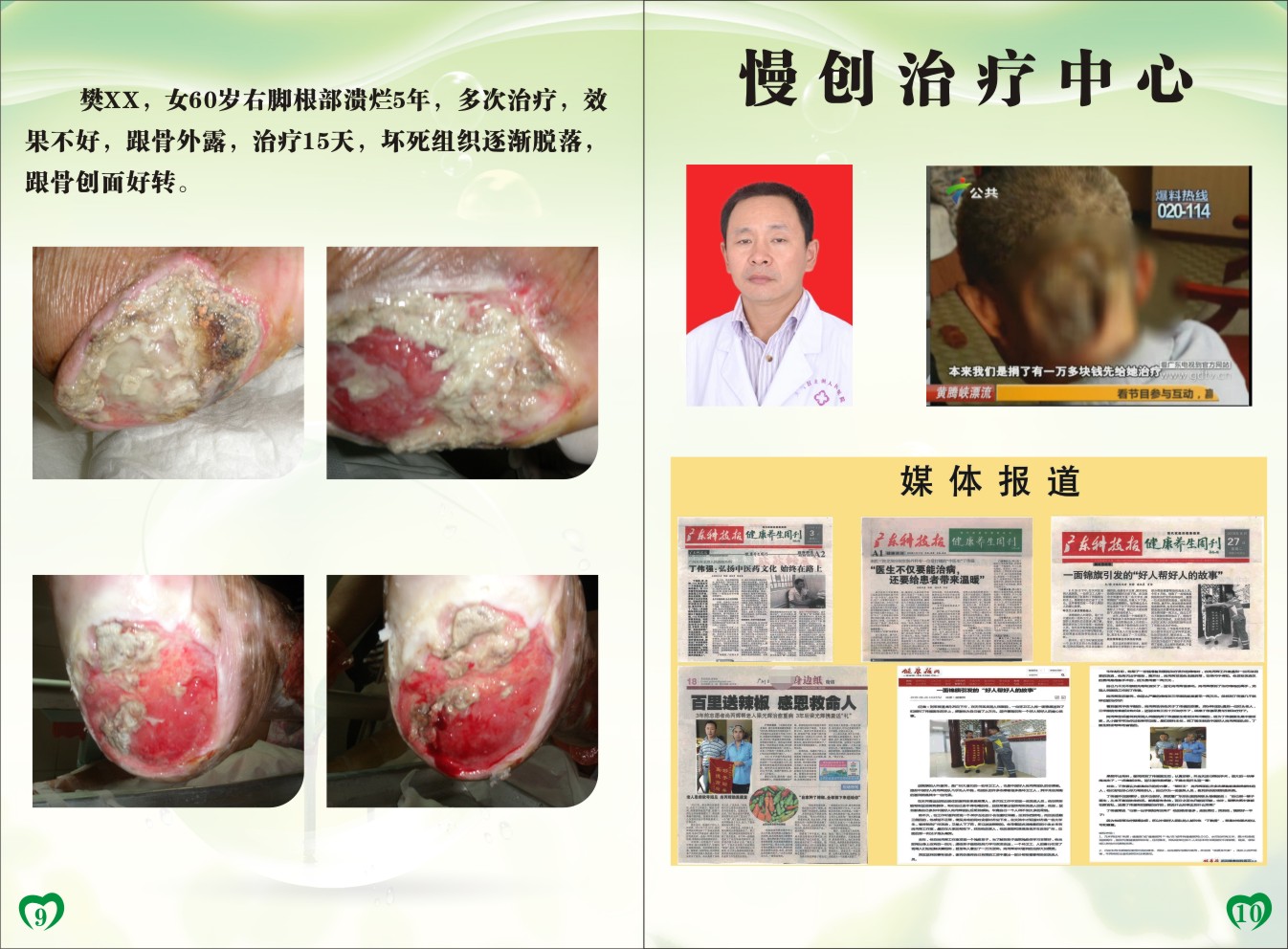 中医特色治疗-坏疽性脓皮病